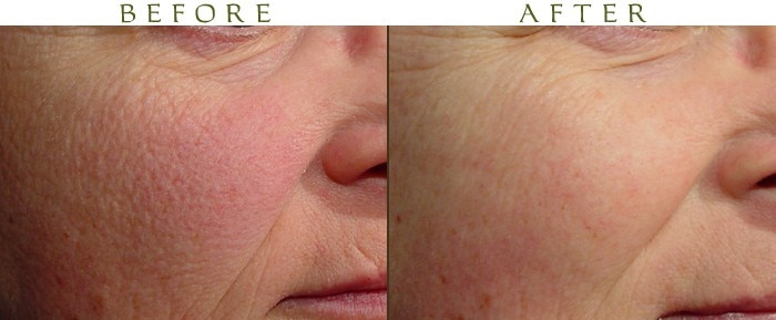 laser genesis before after