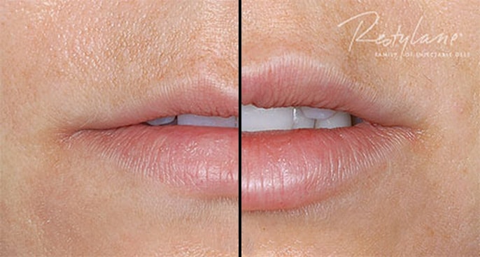 restylane-silk-before-and-after-01