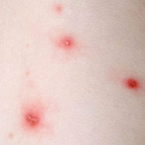 Chickenpox