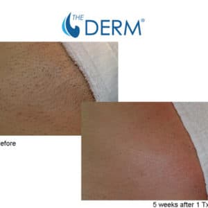 Main-laser-hai-removal-web Main-laser-hai-removal-web