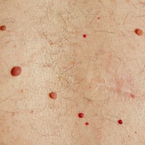 Moles-Cherry-Angiomas