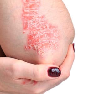Psoriasis