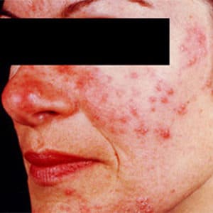 Rosacea skin