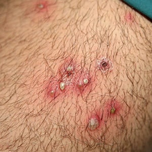 folliculitis