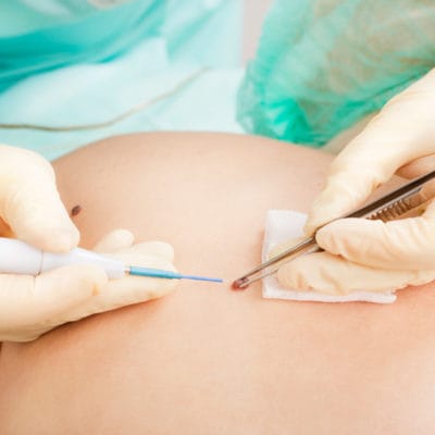 picture of someone getting a mole removed