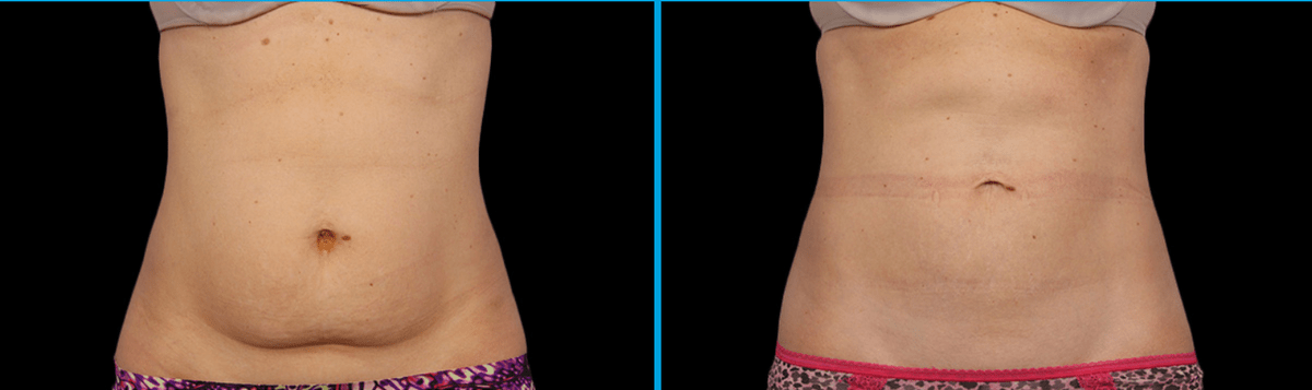 coolsculpting-treatment-before-after coolsculpting fat freeze