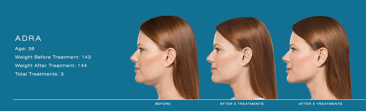 what is kybella