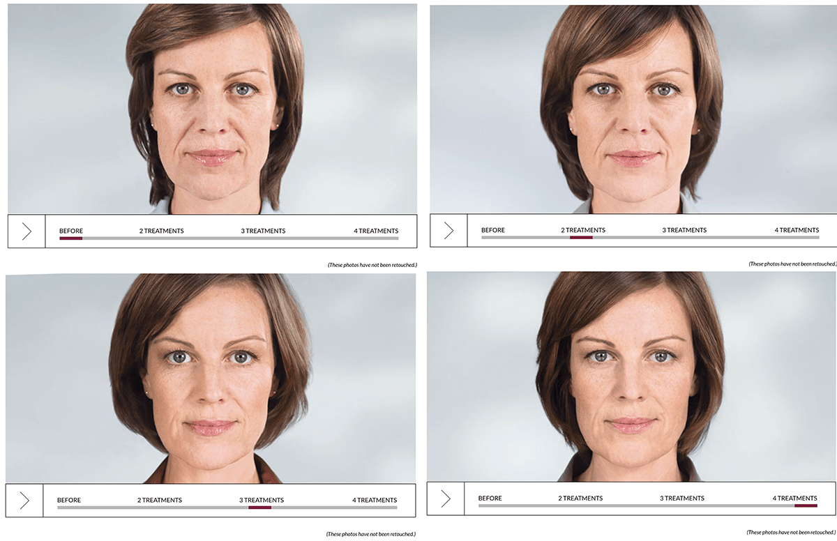 sculptra before and after