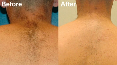 laser hair removal back
