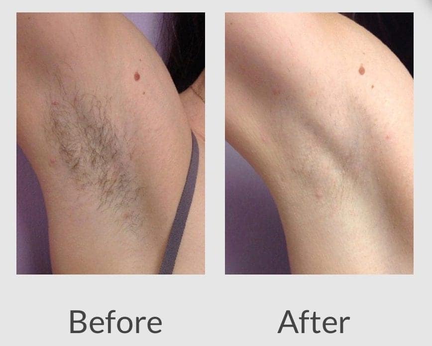 laser hair removal before after