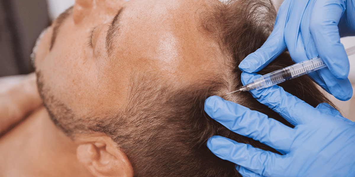 hair loss treatment prp