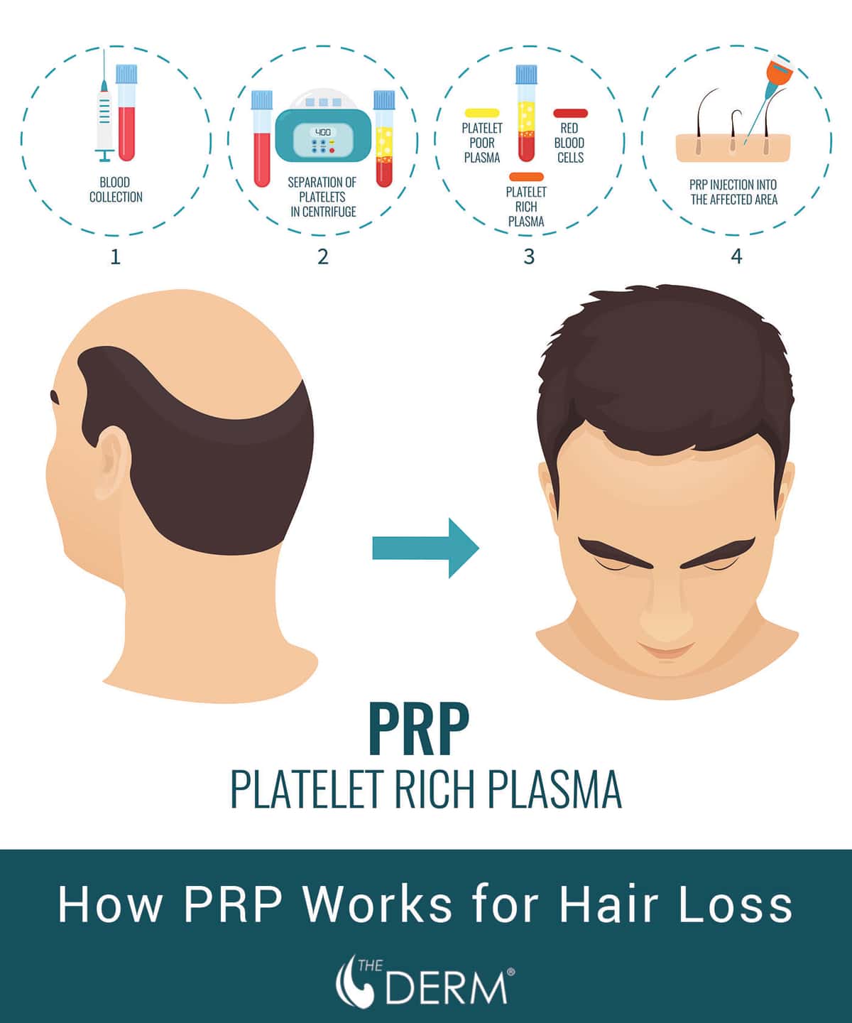 prp for hair loss