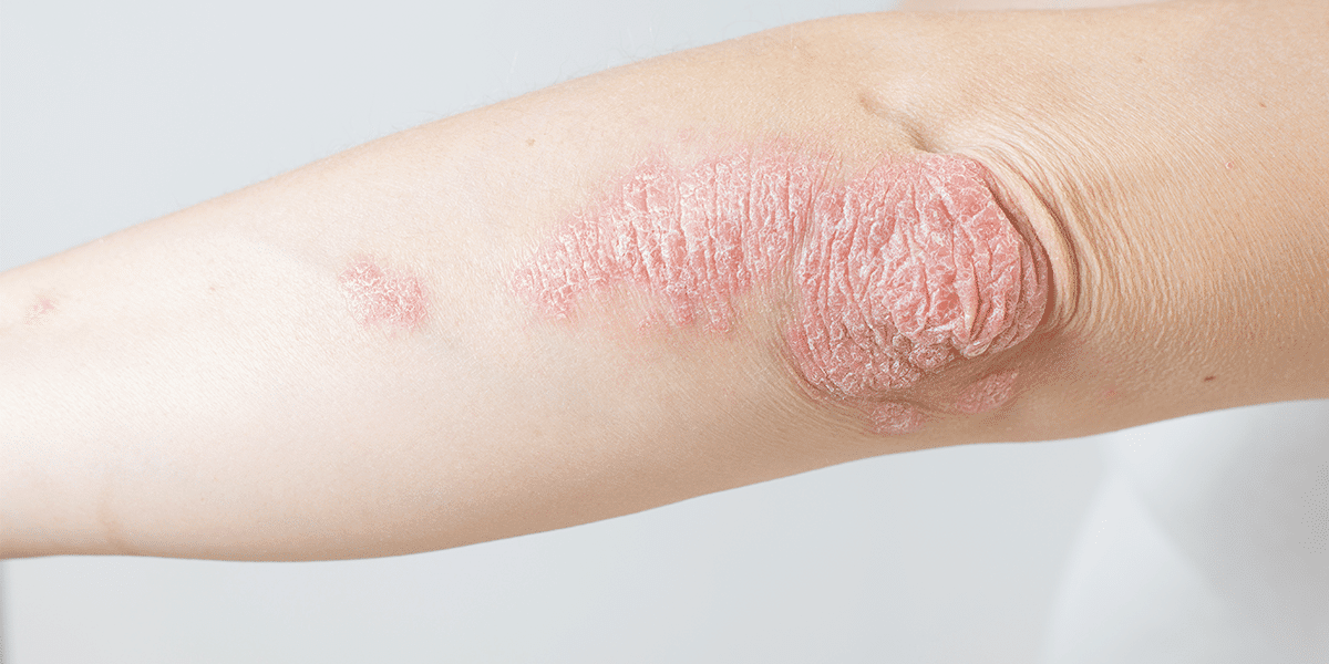 psoriasis