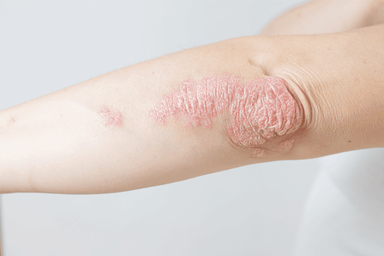 psoriasis psoriasis