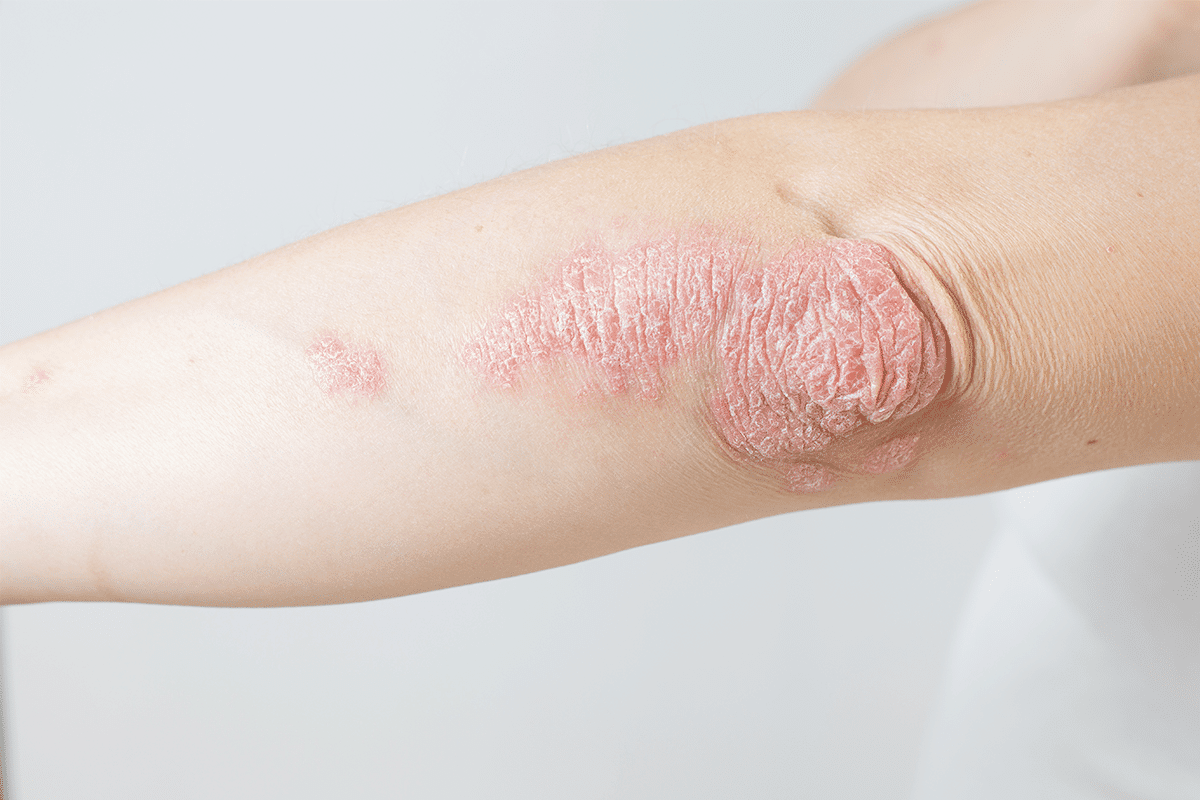 psoriasis