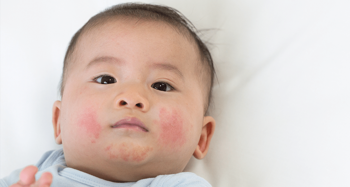 eczema in kids eczema in kids