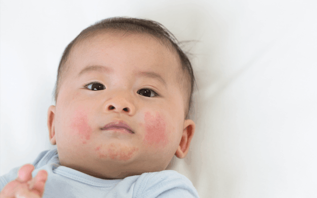 eczema in kids eczema in kids