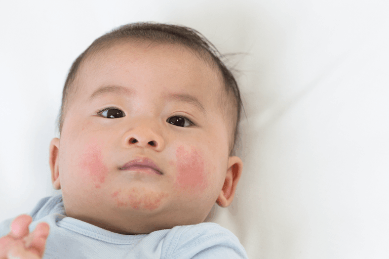 eczema in kids eczema in kids