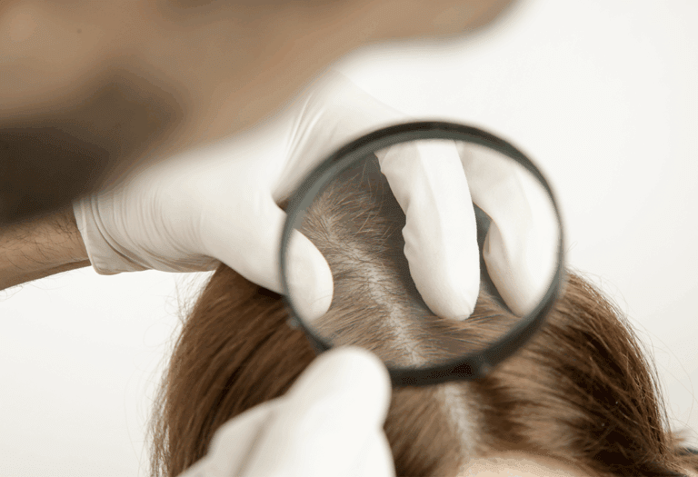 hair loss