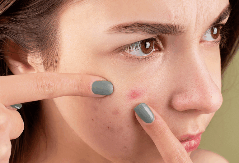all about acne all about acne