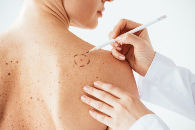 cropped view of dermatologist applying marks on skin of naked woman with melanoma isolated on white
