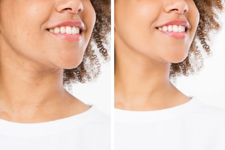 Before after close up african american woman face with acne and problem skin. Beauty skin care treatment. Before-after Facial problems. Dermatology cosmetology changing procedures. Afro beautiful girl
