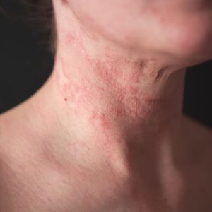 the girl has dermatitis on the neck on a black background