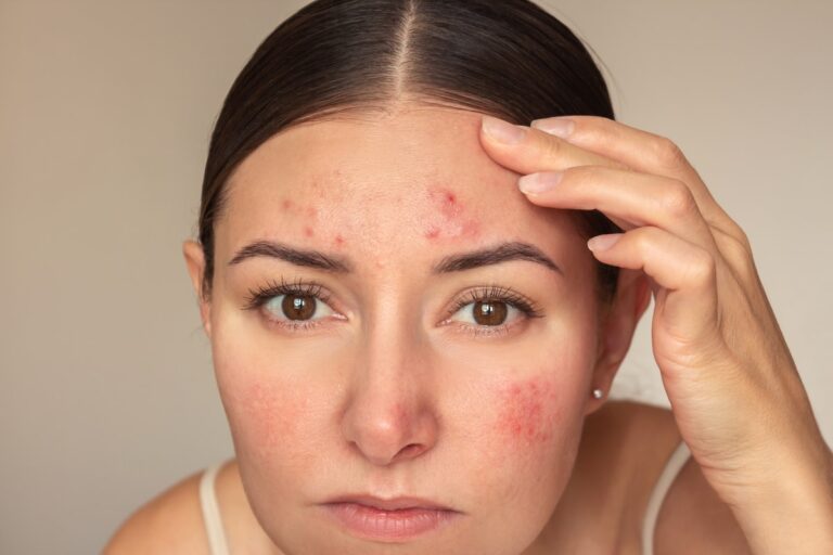 Young caucasian woman looking at camera and examines pimples on her forehead.