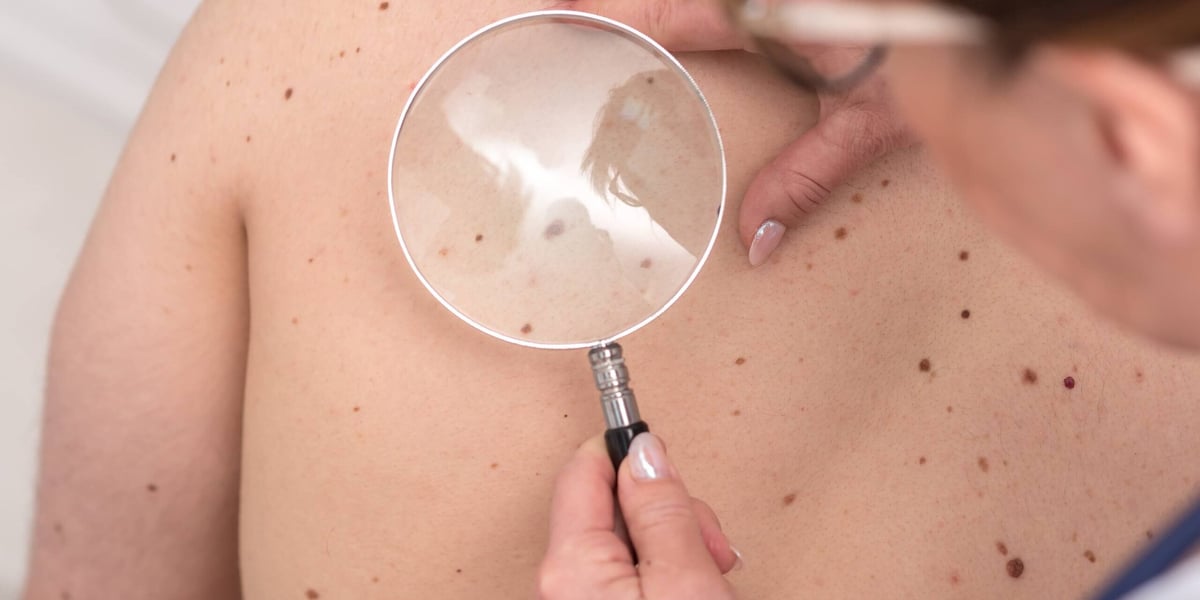 Dermatologist examining the skin of a patient