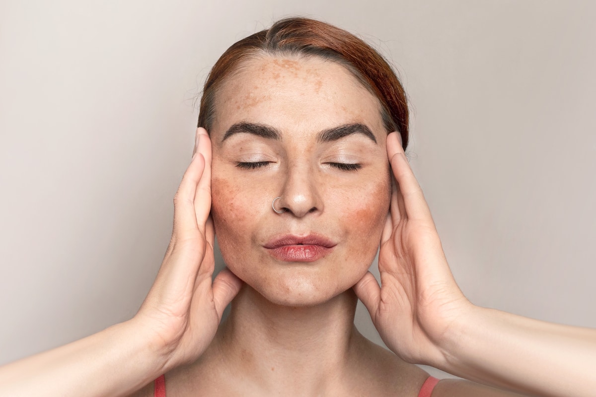 Caucasian woman face with pigmentation, melasma, freckles, age spots photo. Close up