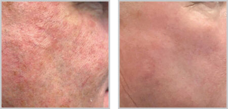 BBL-HEROic-MOXI BBL HEROic MOXI